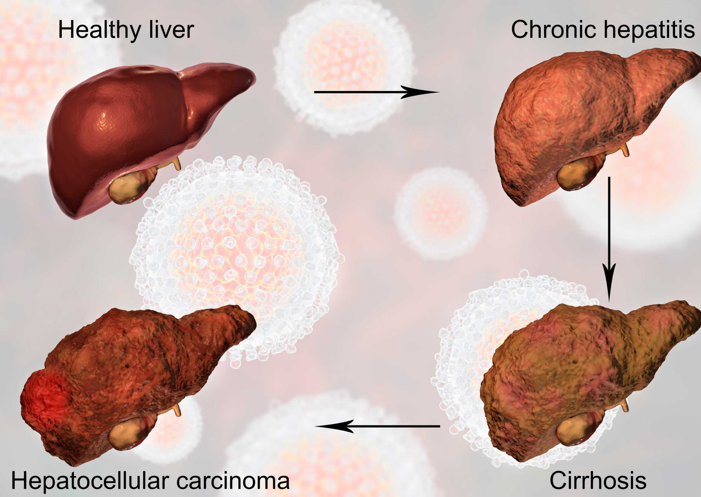 llustratie van leverziekte: van gezonde lever naar hepatitis, cirrose en leverkanker